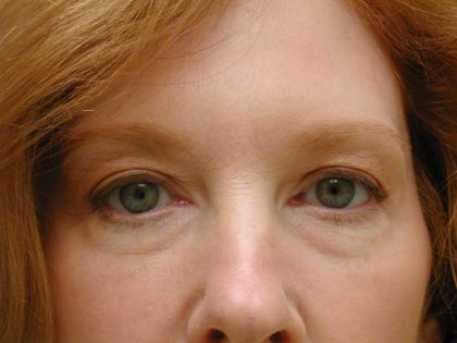 Face/Neck Lift Before & After Patient #8380
