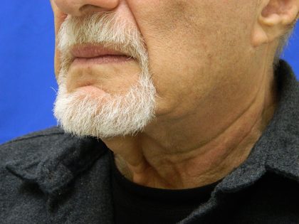 Face/Neck Lift Before & After Patient #8361