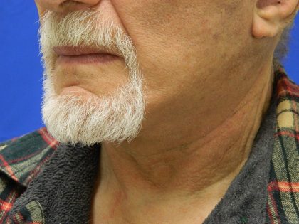 Face/Neck Lift Before & After Patient #8361