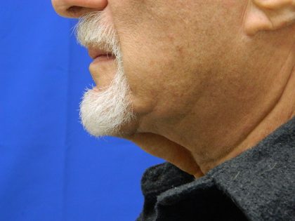 Face/Neck Lift Before & After Patient #8361