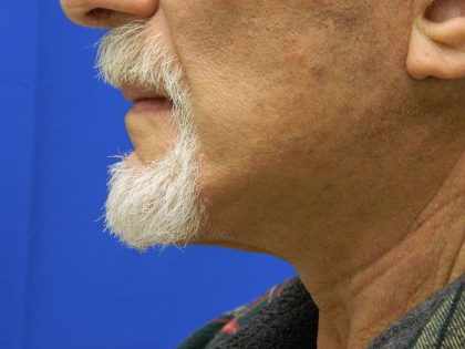 Face/Neck Lift Before & After Patient #8361