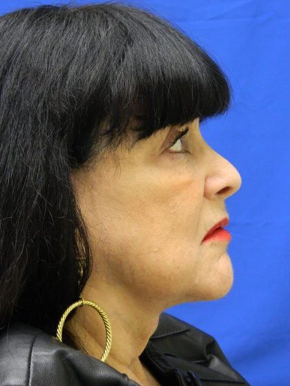 Face/Neck Lift Before & After Patient #8315