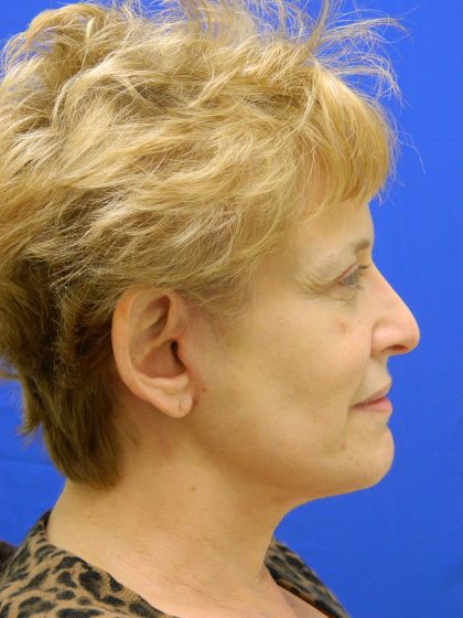 Face/Neck Lift Before & After Patient #8293