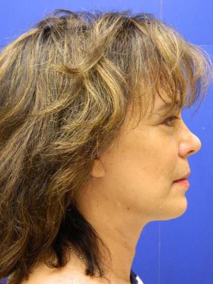 Face/Neck Lift Before & After Patient #8341
