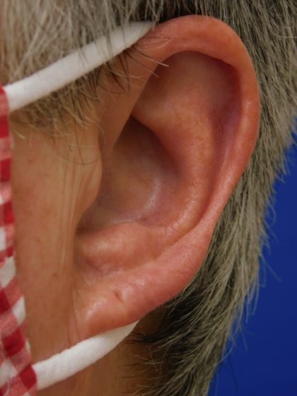 Earlobe Repair Before & After Patient #8282