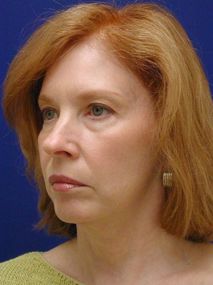 Face/Neck Lift Before & After Patient #8380