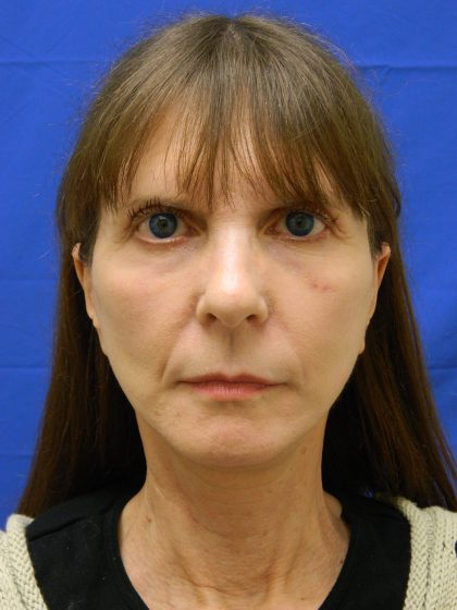 Face/Neck Lift Before & After Patient #8304
