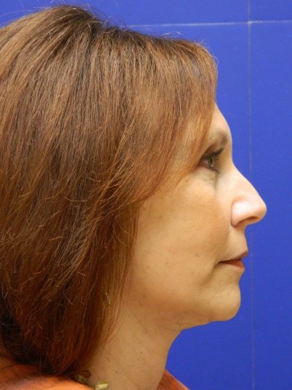 Face/Neck Lift Before & After Patient #8446