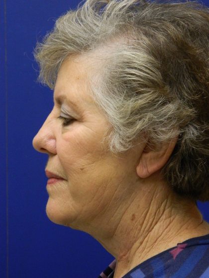 Face/Neck Lift Before & After Patient #8470