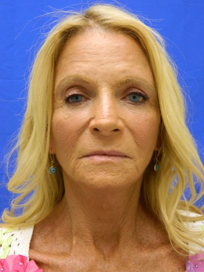 Face/Neck Lift Before & After Patient #8479