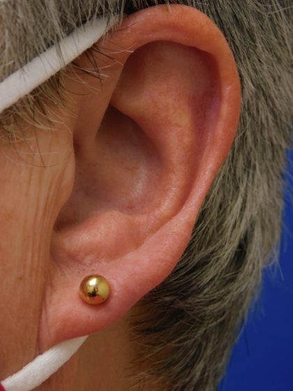 Earlobe Repair Before & After Patient #8282