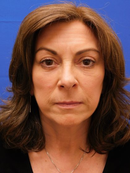 Face/Neck Lift Before & After Patient #8459