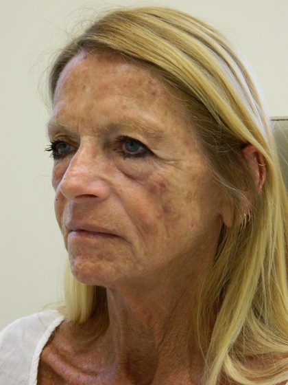 Face/Neck Lift Before & After Patient #8479