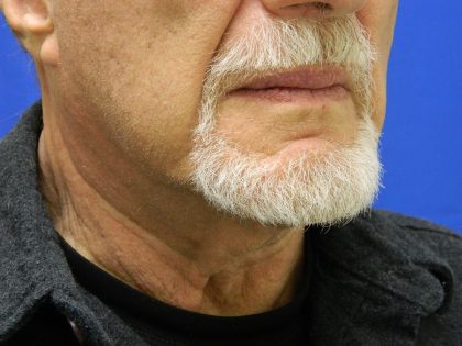 Face/Neck Lift Before & After Patient #8361