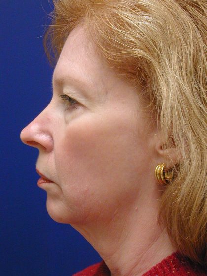Face/Neck Lift Before & After Patient #8380