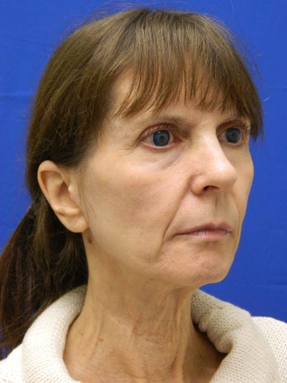 Face/Neck Lift Before & After Patient #8304