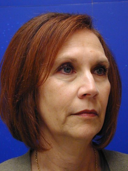 Face/Neck Lift Before & After Patient #8446