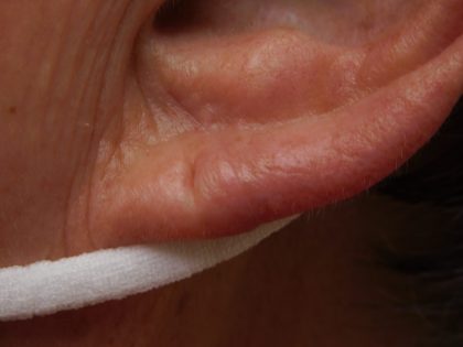Earlobe Repair Before & After Patient #8282