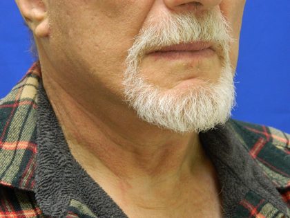 Face/Neck Lift Before & After Patient #8361