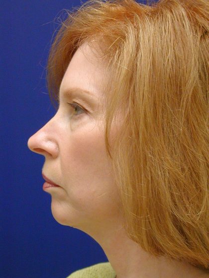 Face/Neck Lift Before & After Patient #8380