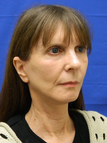 Face/Neck Lift Before & After Patient #8304