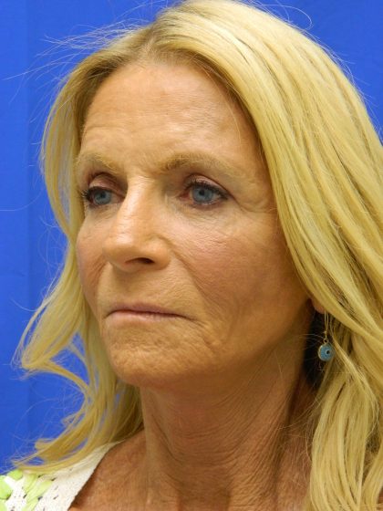 Face/Neck Lift Before & After Patient #8479