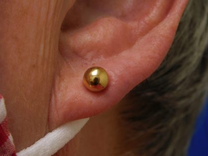 Earlobe Repair Before & After Patient #8282