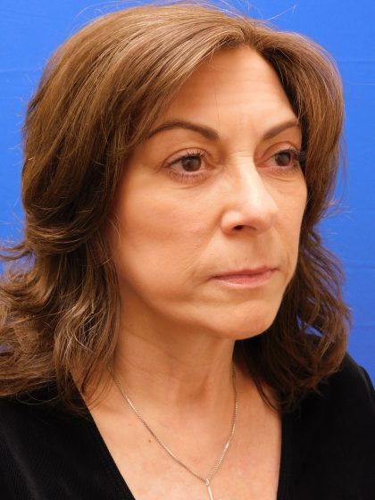 Face/Neck Lift Before & After Patient #8459