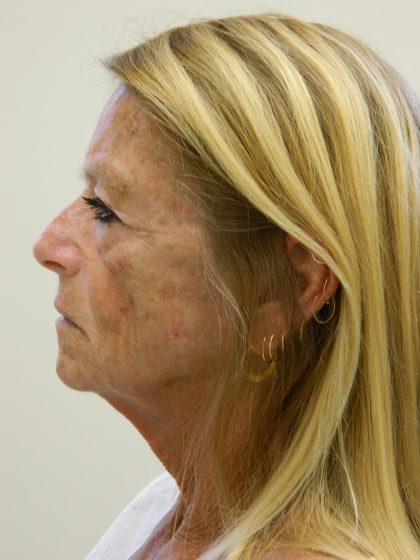 Face/Neck Lift Before & After Patient #8479