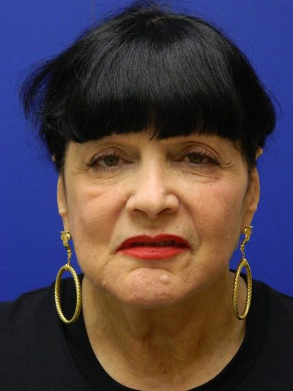 Face/Neck Lift Before & After Patient #8315
