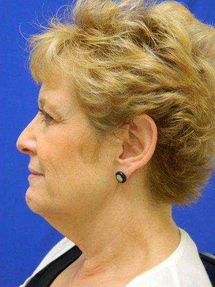 Face/Neck Lift Before & After Patient #8293