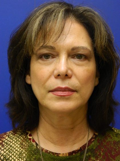 Face/Neck Lift Before & After Patient #8341