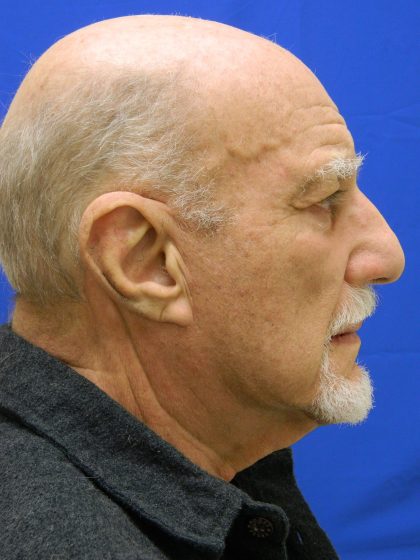 Face/Neck Lift Before & After Patient #8361