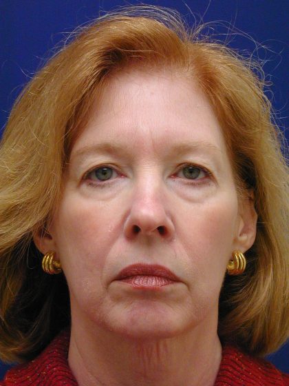 Face/Neck Lift Before & After Patient #8380
