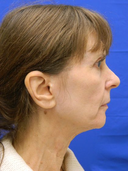 Face/Neck Lift Before & After Patient #8304
