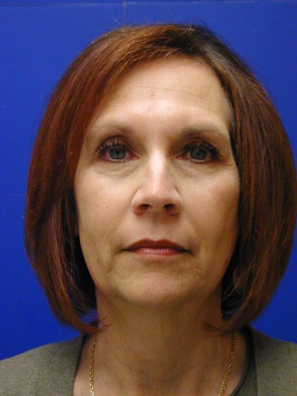 Face/Neck Lift Before & After Patient #8446