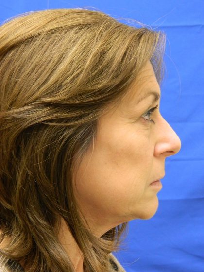 Face/Neck Lift Before & After Patient #8459
