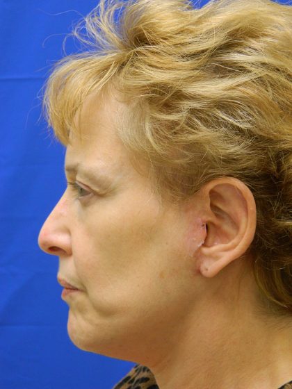 Face/Neck Lift Before & After Patient #8293