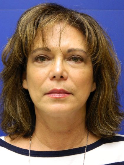 Face/Neck Lift Before & After Patient #8341
