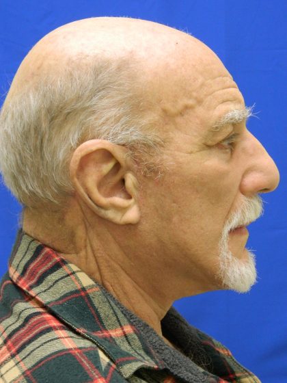 Face/Neck Lift Before & After Patient #8361