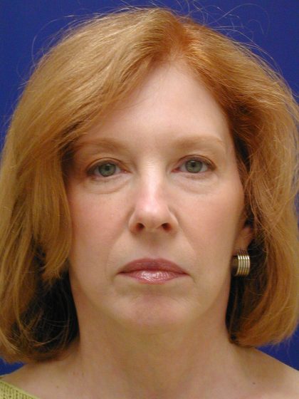 Face/Neck Lift Before & After Patient #8380