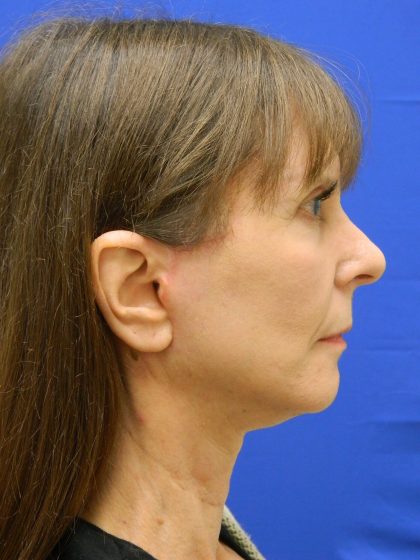 Face/Neck Lift Before & After Patient #8304