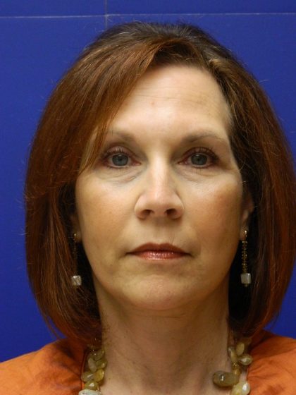 Face/Neck Lift Before & After Patient #8446