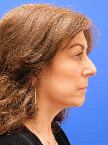 Face/Neck Lift Before & After Patient #8459