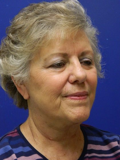 Face/Neck Lift Before & After Patient #8470