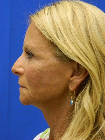 Face/Neck Lift Before & After Patient #8479