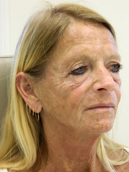 Face/Neck Lift Before & After Patient #8479