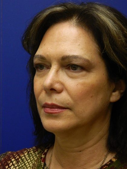Face/Neck Lift Before & After Patient #8341