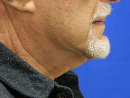 Face/Neck Lift Before & After Patient #8361