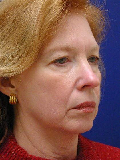 Face/Neck Lift Before & After Patient #8380